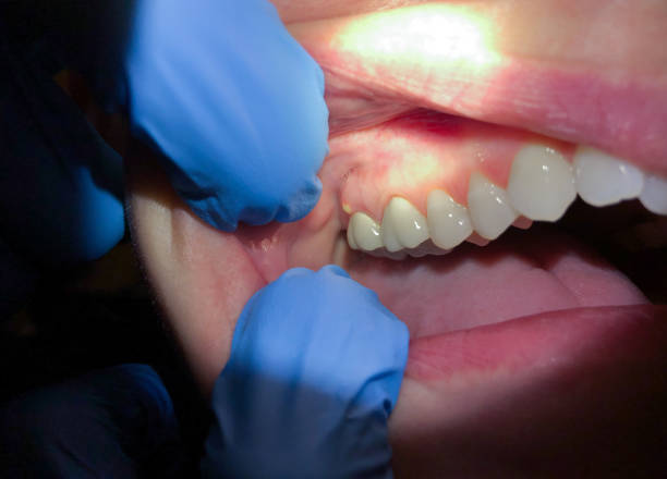 Best Broken or Cracked Tooth Emergency Dentist in Frederick, CO