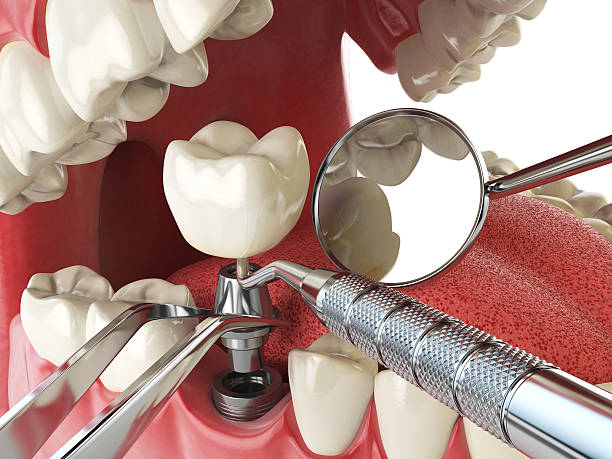 Best Emergency Root Canal Treatment in Frederick, CO